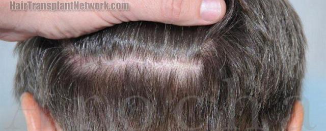 Residual scar from hair transplant donor area