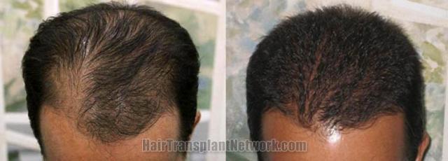Top view - Before and after hair transplantation photos