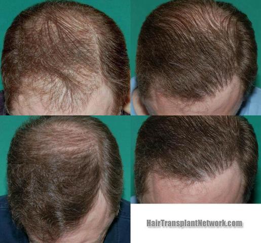 Top views - Before and after two hair restoration sessions