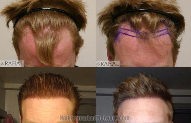 Top view before and after hair restoration results