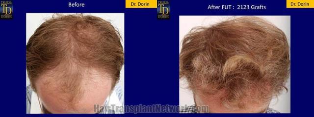 Hair restoration procedure before and after results