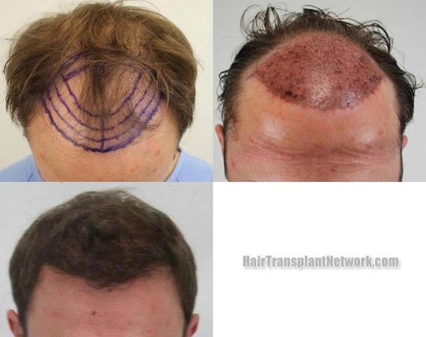 Top view before and after hair restoration results