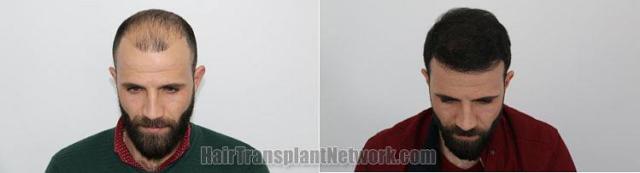 Before and after hair restoration procedure images