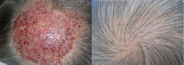 Before and after pictures of  hair transplant to the crown