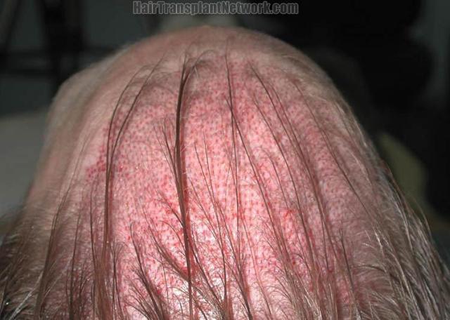Top immediate postoperative hair transplant image