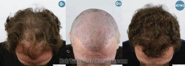 Hair transplantation surgery before and after images