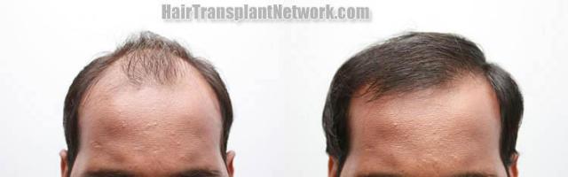 Before and after hair restoration procedure images