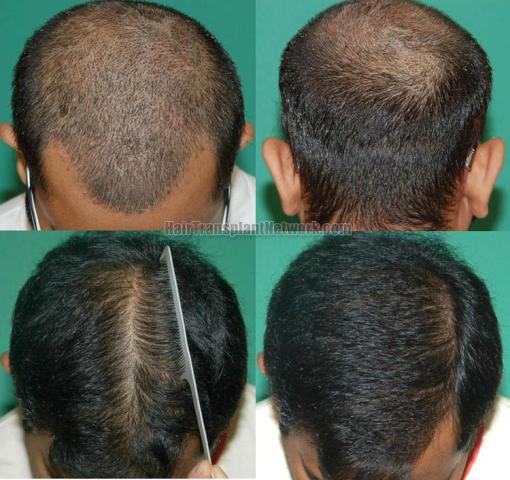 Hair transplantation surgery before and after photos