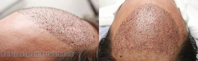 Immediate postoperative images of hair transplant