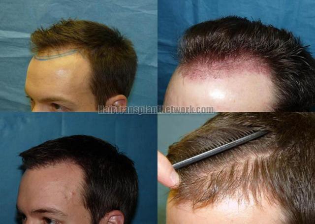 Left view - Before and after hair transplantation procedure