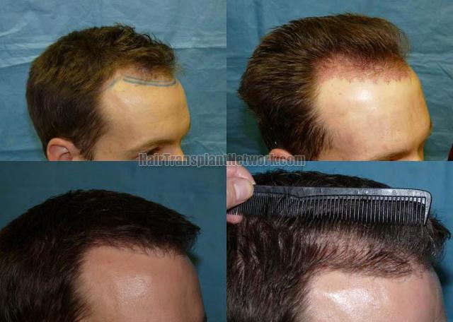 Hair restoration procedure results photographs