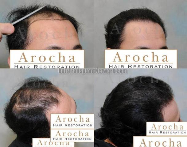 Right view - Before and after hair transplant session