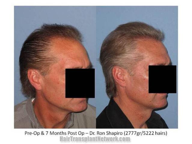 Right view before and after hair replacement surgery