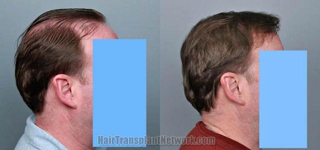 Hair restoration procedure before and after results