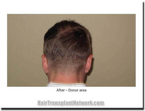 Hair restoration procedure results