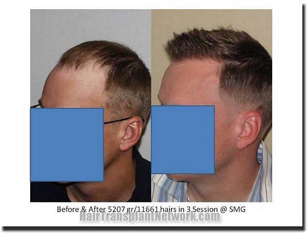 Hair restoration procedure results