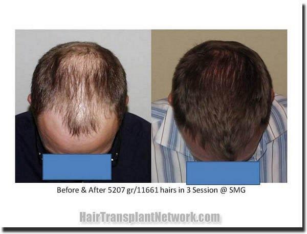 Hair restoration procedure results