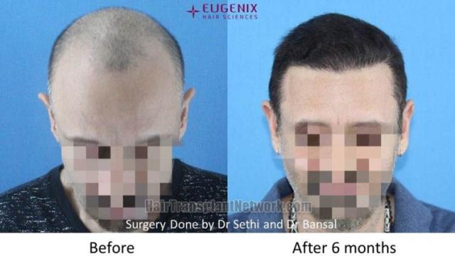 Before and after BHT FUE hair restoration procedure images