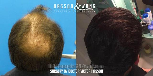 Hair transplantation procedure before and after photographs