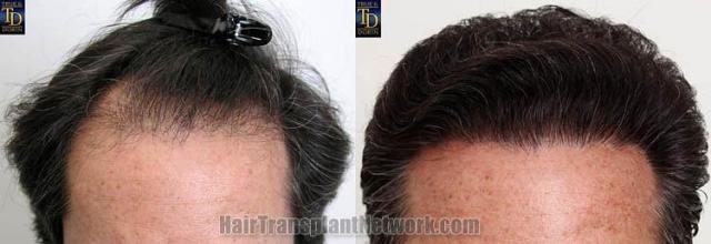 Hair restoration procedure before and after results,