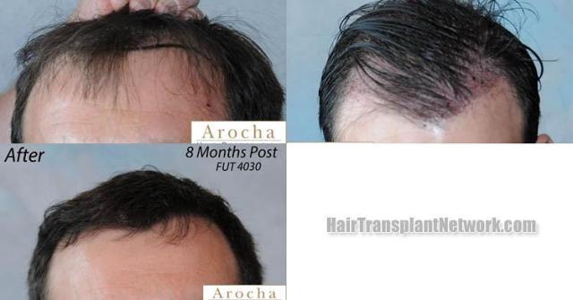 Hair restoration procedure before and after results