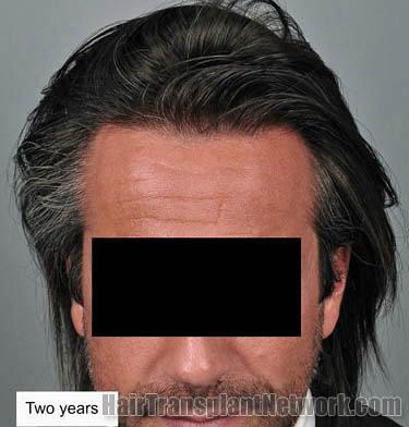 Front view - Before and after hair restoration surgery