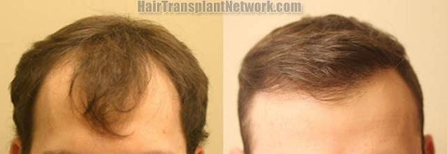 Hair restoration procedure before and after results