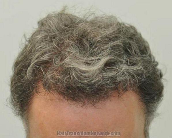 Hair restoration surgery result photos 10 months postoperative