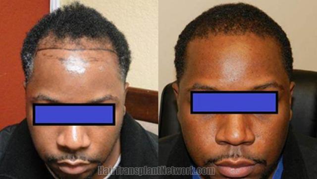 Dr John Diep Hair Transplantation Fue Procedure Before And After