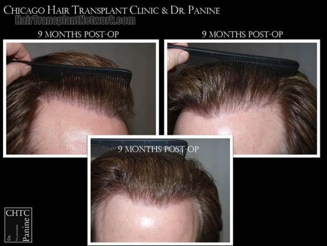 Hair restoration procedure before and after pictures