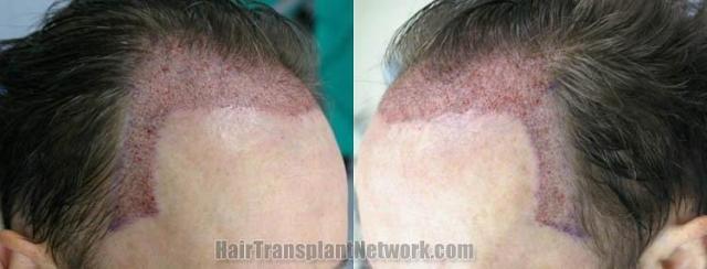 Hair restoration procedure before and after pictures