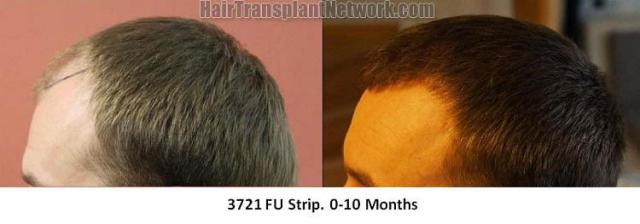 Hair transplantation surgery before and after images