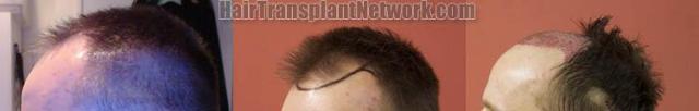 Hair transplantation surgery before and after images