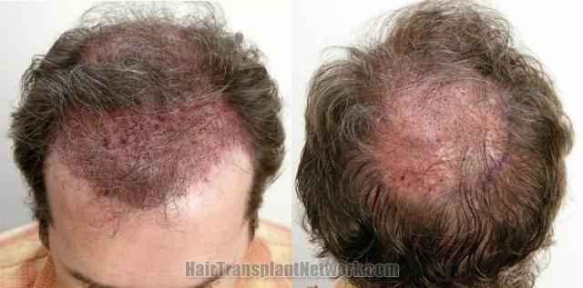 Immediate postoperative hair transplant photos