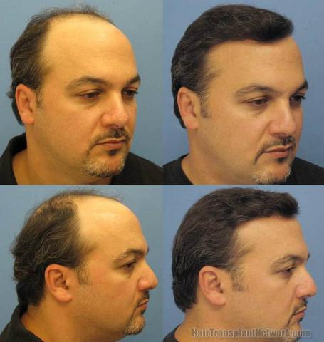 Right view - Before and after hair restoration procedure