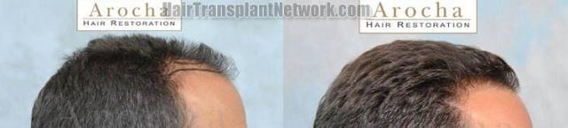 Before and after hair replacement surgery procedure