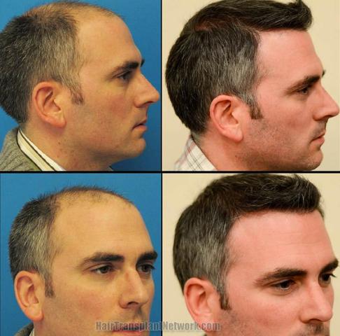 Hair transplantation surgery before and after images