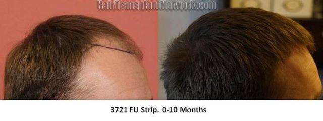 Hair transplantation surgery before and after photos