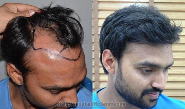 Hair transplantation surgery before and after photos