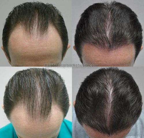 Hair transplantation surgery before and after photos