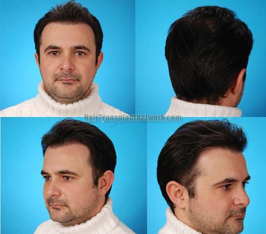 Hair restoration procedure before and after result photographs
