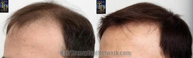 Hair transplantation surgery before and after pictures