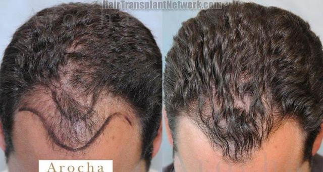 Top view before and after hair transplantation procedure 