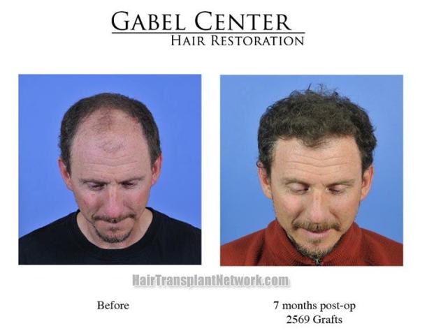 Top view - Before and after hair replacement procedure