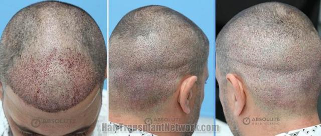 Hair Transplant Immediate postoperative images