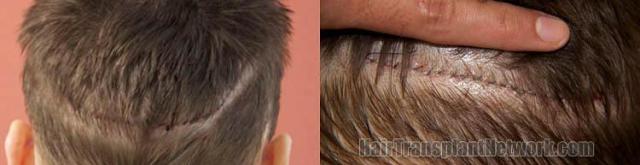 Surgical hair transplantation result photographs