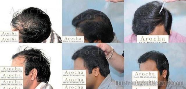 Left side photos of before and after hair transplant