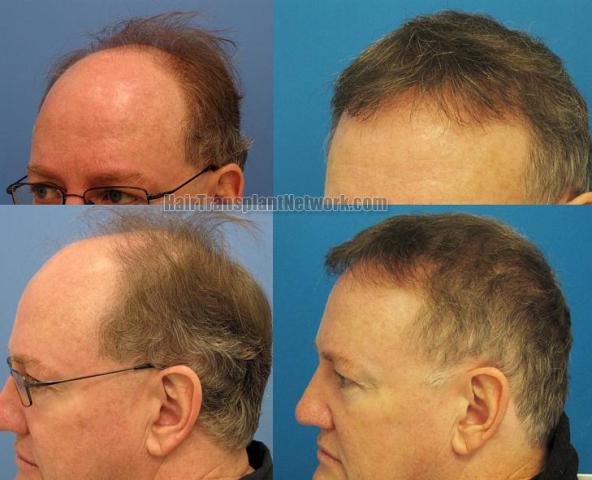 Hair transplantation surgery before and after pictures