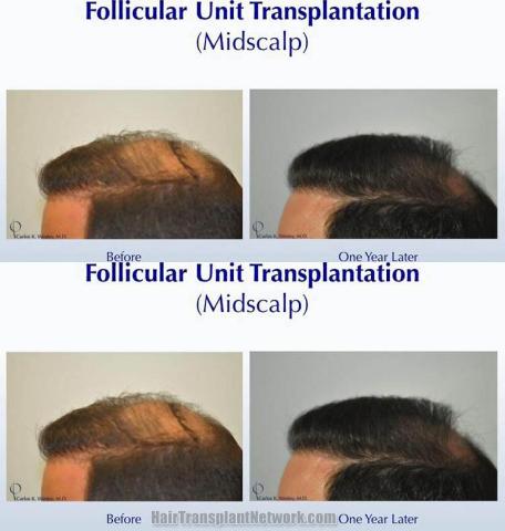 Hair transplantation surgery before and after pictures