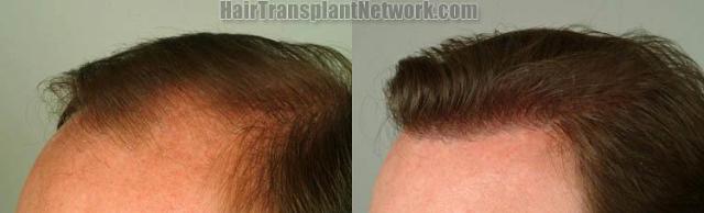 Hair restoration surgical procedure before and after pictures